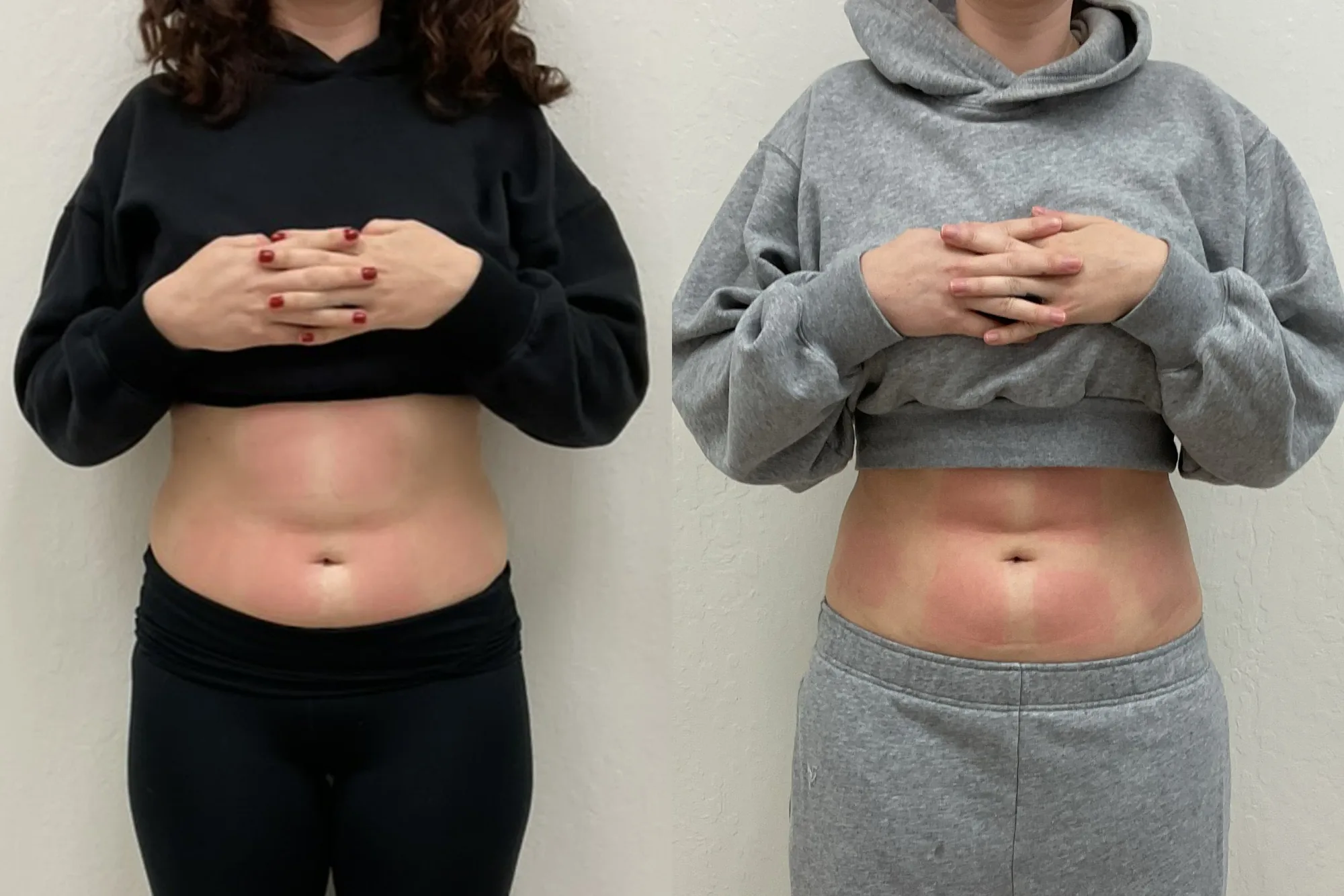 Before and after Evolve body contouring, front view of a woman's abdomen, smoother and flatter after