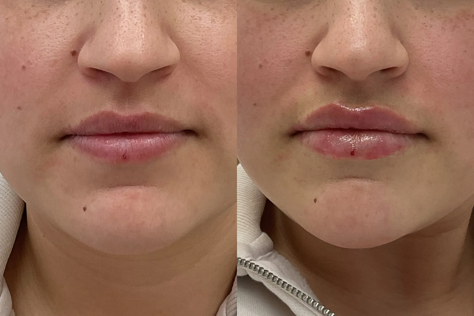 Before and after lip filler side by side, front view, with subtle added volume